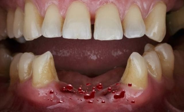 Chi tiết ý nghĩa giấc mơ gãy răng chảy máu mang thông điệp gì?