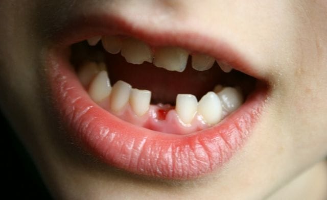 Chi tiết ý nghĩa giấc mộng thấy gãy răng không chảy máu theo từng bối cảnh