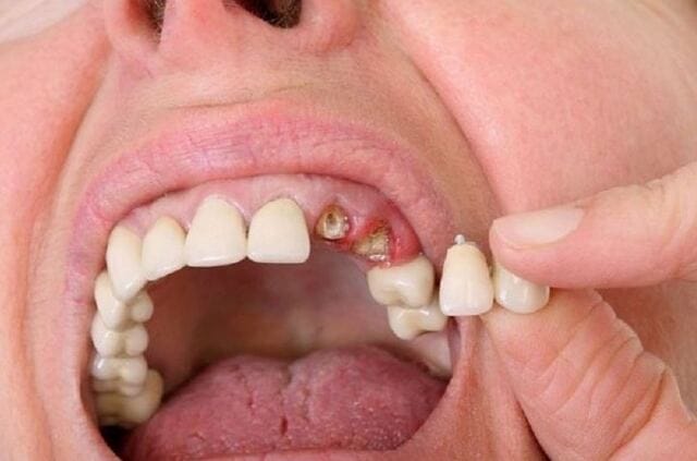 Chiêm bao thấy mình nhổ răng sâu thường mang ý nghĩa tốt cho chính người mơ