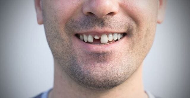 Chiêm bao thấy răng cửa bị gãy có thể khiến nhiều người lo lắng, sợ hãi