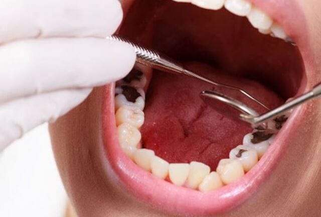Đánh số gì khi mộng thấy răng sâu?