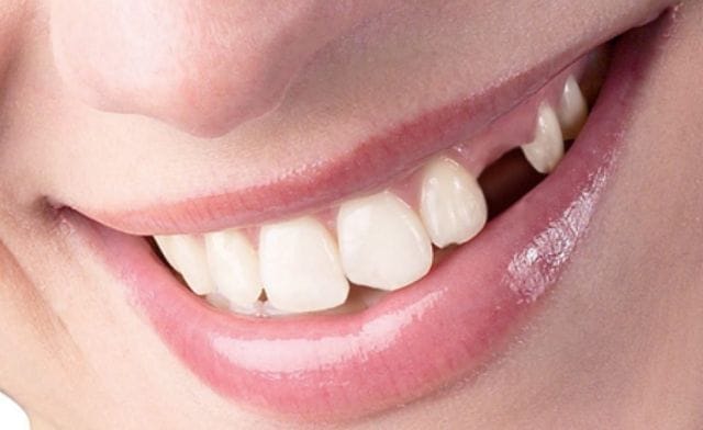 Dưới góc độ tâm linh mơ gãy răng chảy máu sẽ có ý nghĩa ra sao