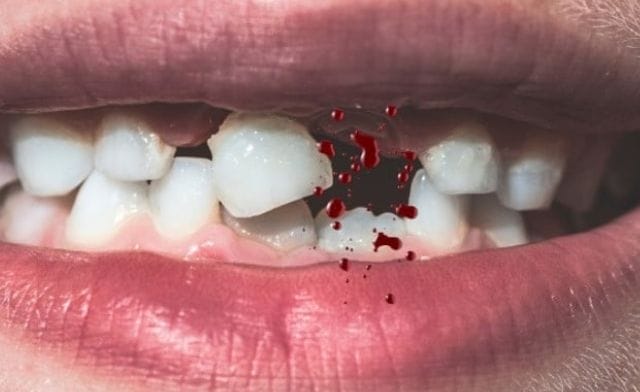 Mơ thấy gãy răng chảy tương ứng với con số tài lộc nào?