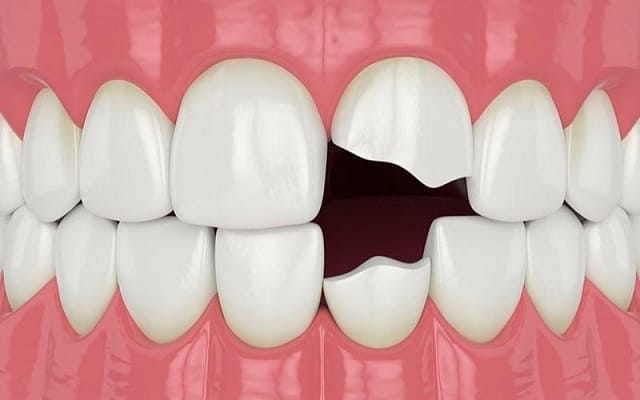 Nằm mơ thấy răng cửa bị gãy thành nhiều mảnh