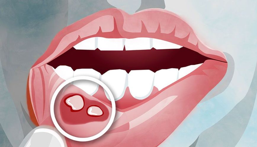 Cắn phải môi dưới nhiều lần tại cùng một vị trí