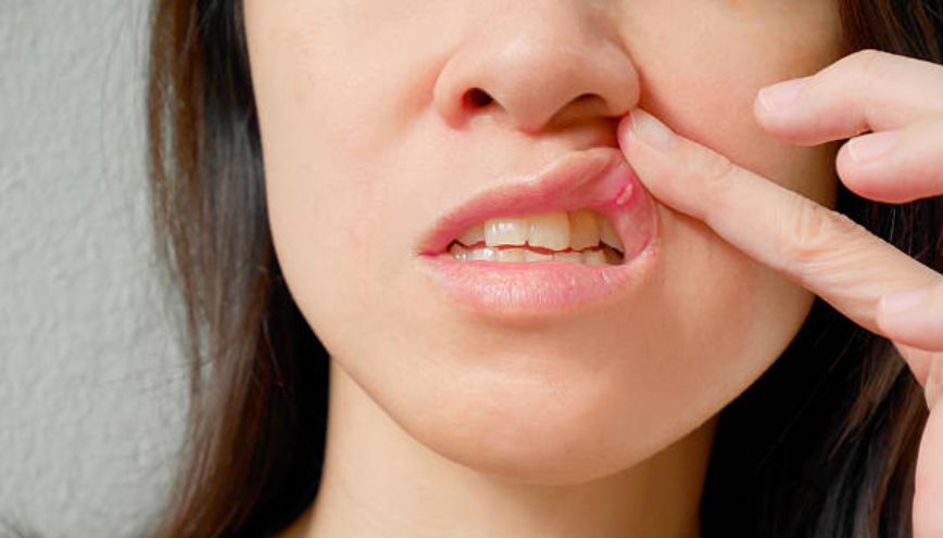Chẳng may cắn vào môi trên khi đang ăn uống hoặc trò chuyện