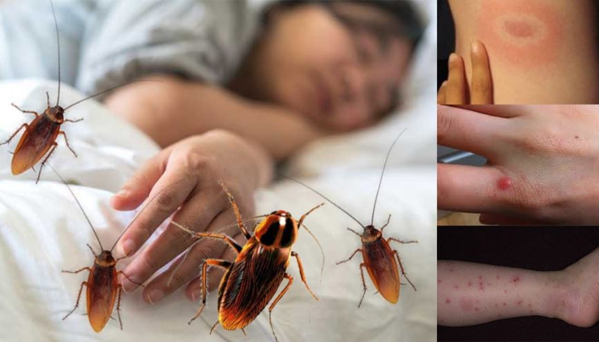Đang ngủ bị gián cắn vào tay